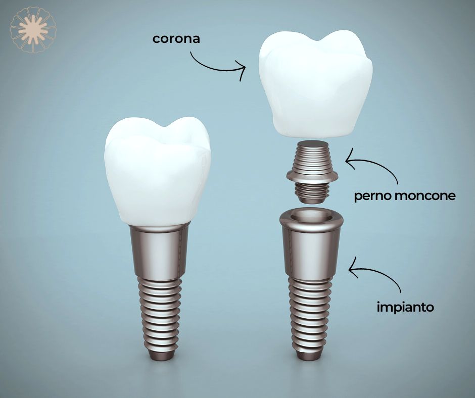implantologia-pisa-struttura-impianto-dentale