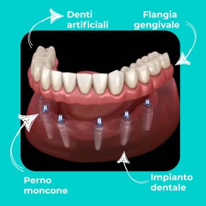 Le parti di una protesi Toronto Bridge - dentista per implantologia Pisa