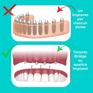 Differenza tra protesi Toronto Bridge su 4 impianti e protesi fissa con impianto per ogni dente - Dentista Sainati Pisa