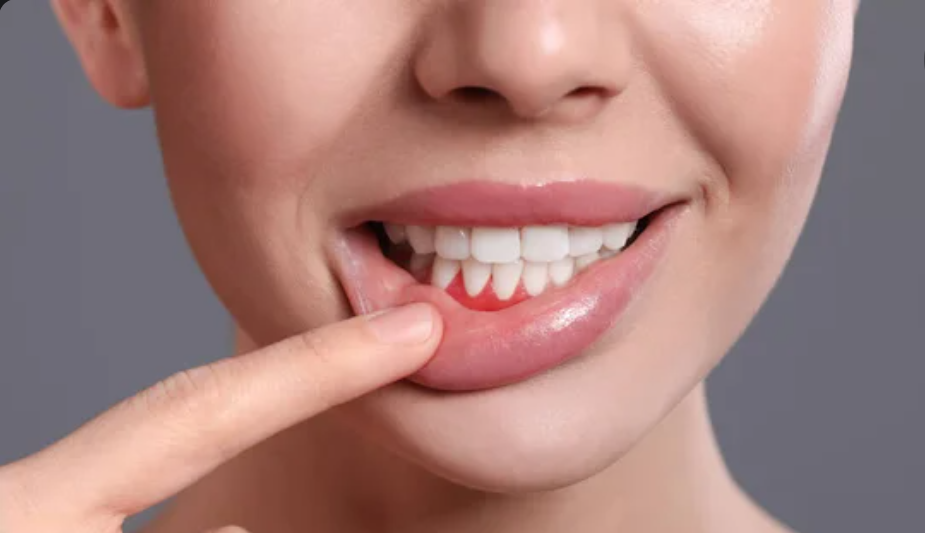 parodontite-non-curata-conseguenze-malattie-studio-dentistico-sainati-pisa